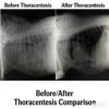 Animal Thoracoabdominal Effusion Drainage Catheter