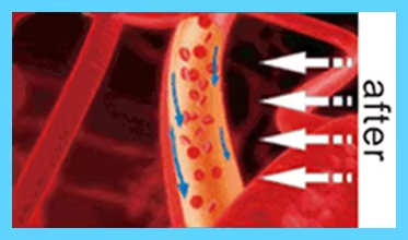 IWA-RLT40 — illustration of local circulation response after red light therapy