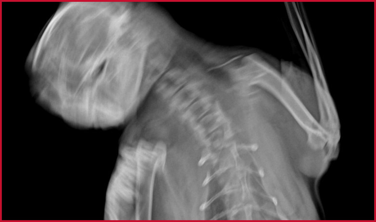 Enlarged head and neck: skull, mandible, cervical vertebrae and scapula all show double contours